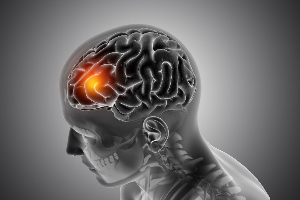 Fighting for What You Deserve: A Guide to Brain Injury Cases in Baltimore